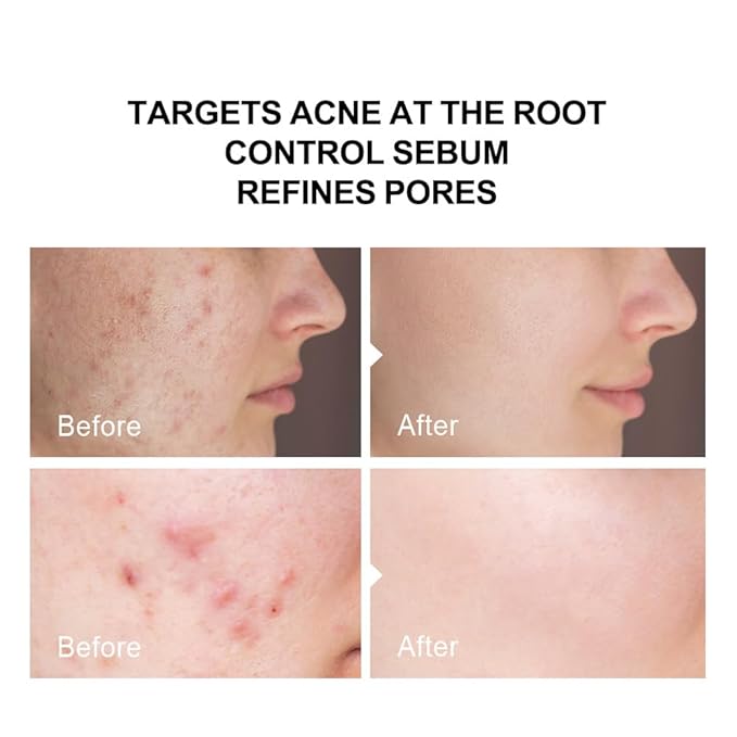 Anti Acne Serum | Serum for Acne & Blackheads | Unclogs Pores | Oil Control | Sensitive-Skin Safe