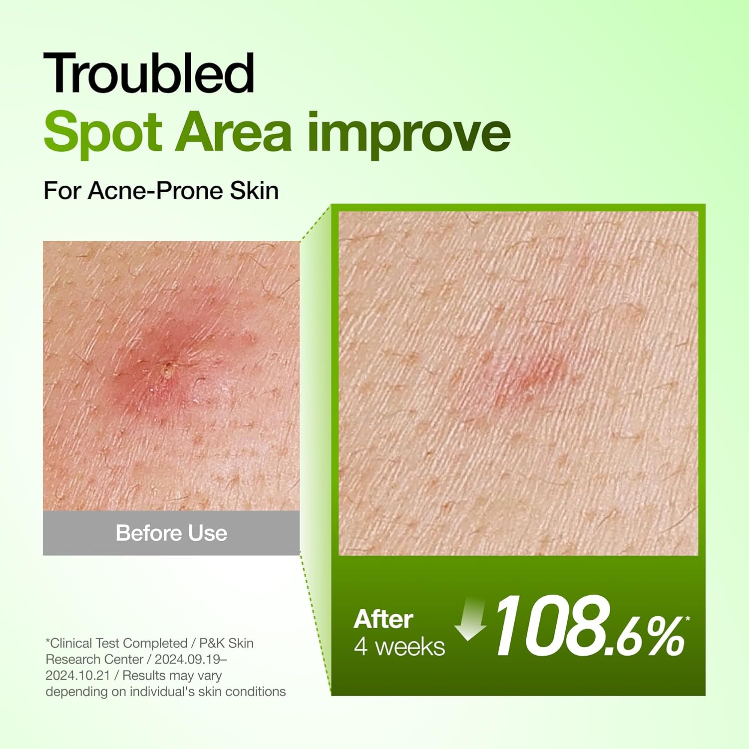 Anti Acne Serum